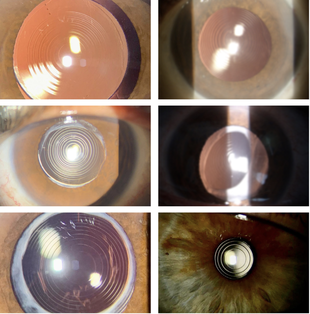 Ojos con diferentes tipos de padecimientos trifocales